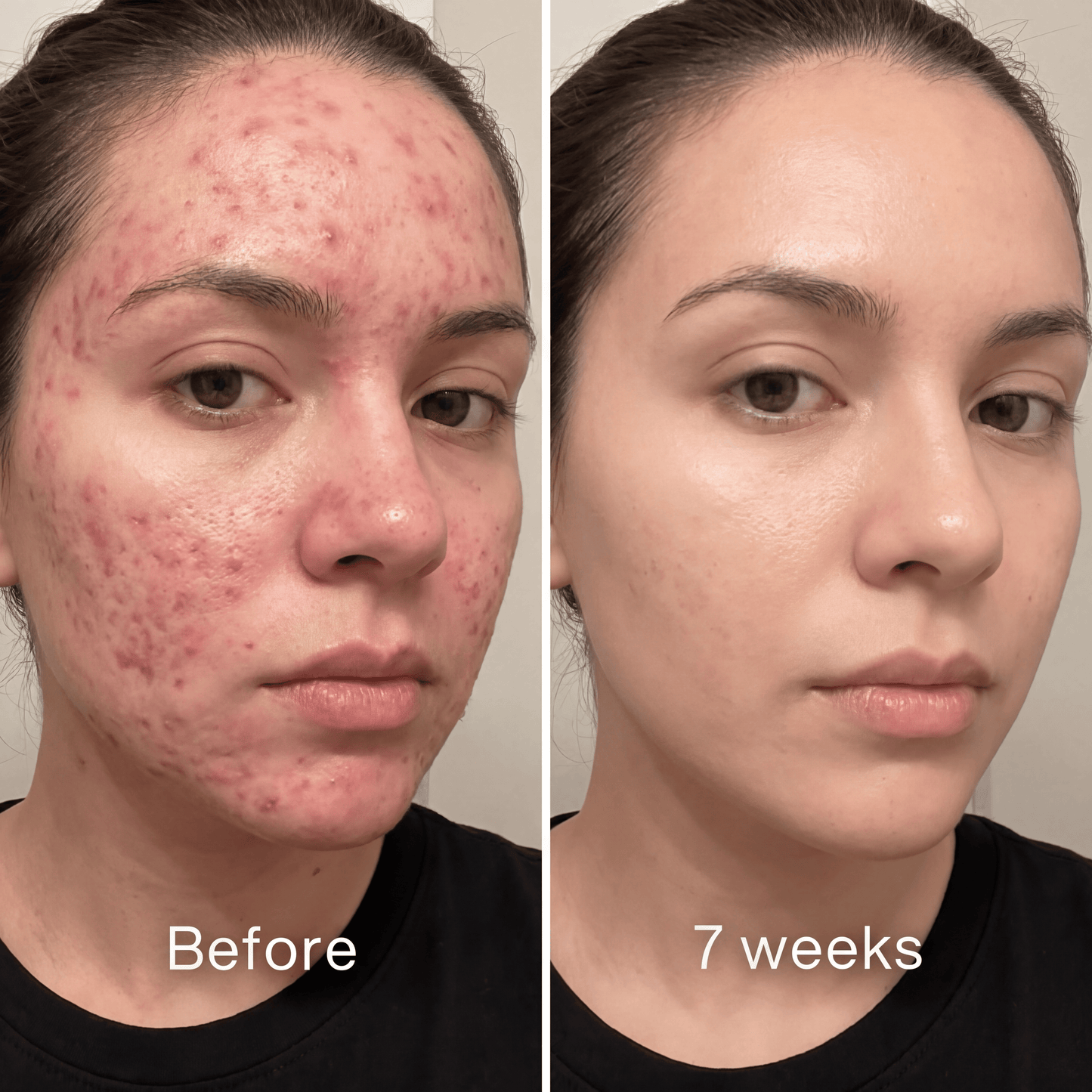 Clinical Acne Scar Repair Stick