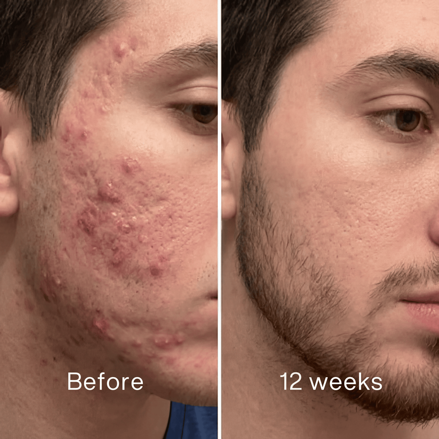 Clinical Acne Scar Repair Stick