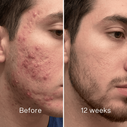 Clinical Acne Scar Repair Stick
